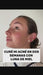 Como eliminar el acne